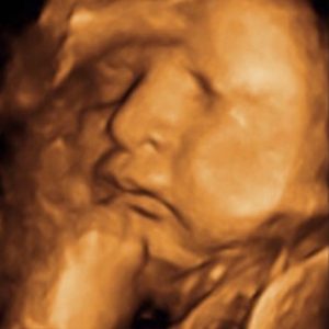 3D Ultrasound Photos